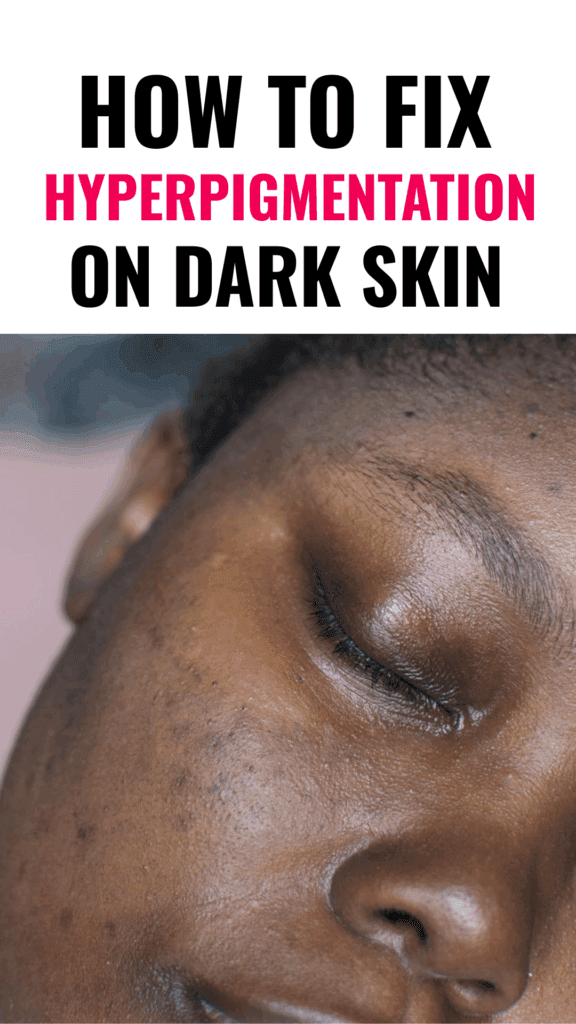 How To Fix Hyperpigmentation On Dark Skin 2 How To Fix Hyperpigmentation On Dark Skin