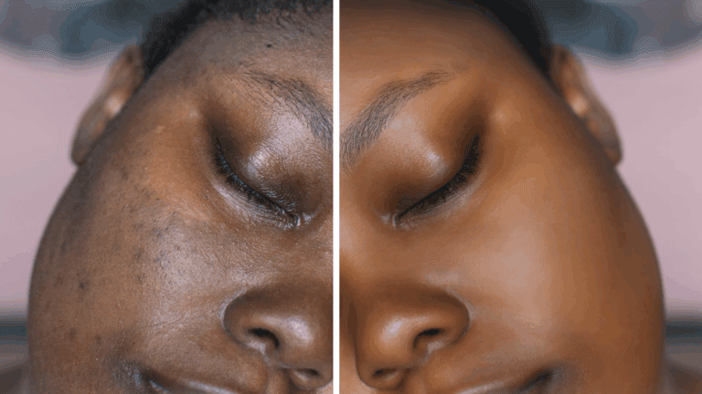 How To Fix Hyperpigmentation On Dark Skin