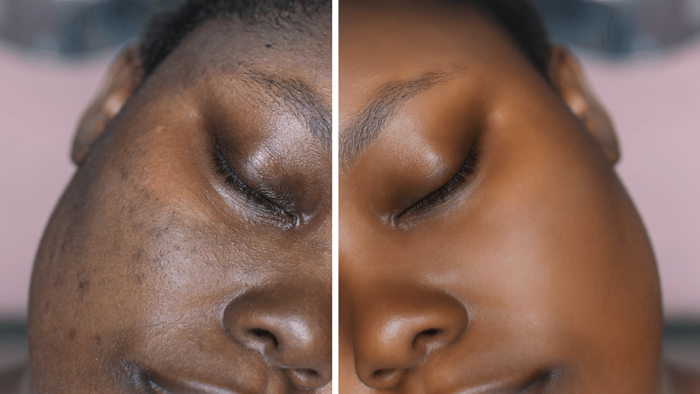 How To Fix Hyperpigmentation On Dark Skin 1 How To Fix Hyperpigmentation On Dark Skin