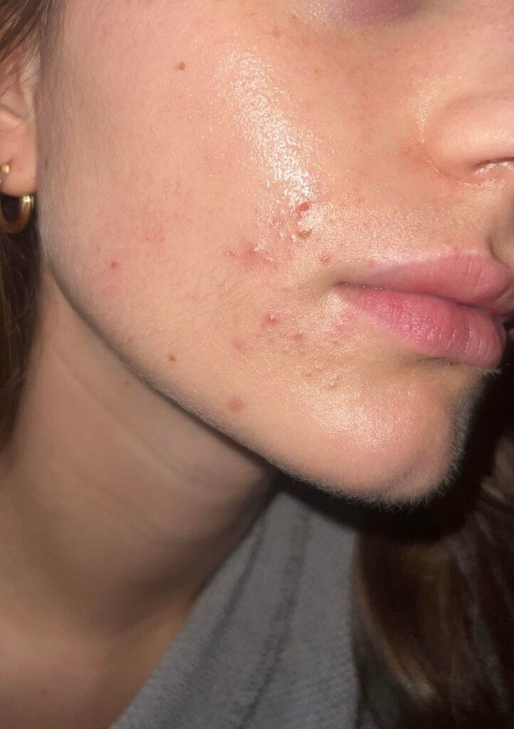 How To Stop Breakouts Around The Mouth 2 How To Stop Breakouts Around The Mouth