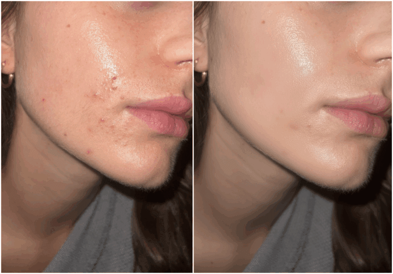 How To Stop Breakouts Around The Mouth